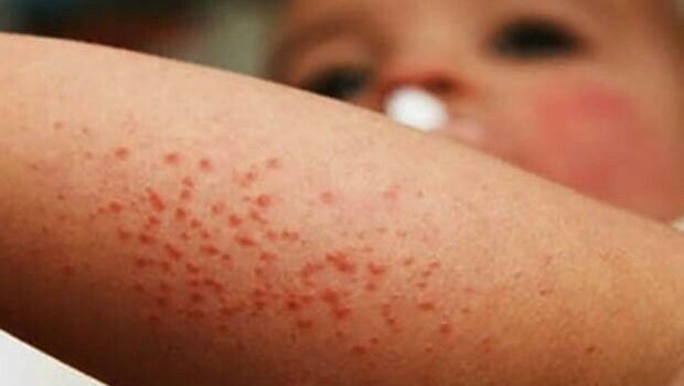 Fallece niño por brote de sarampión en Texas